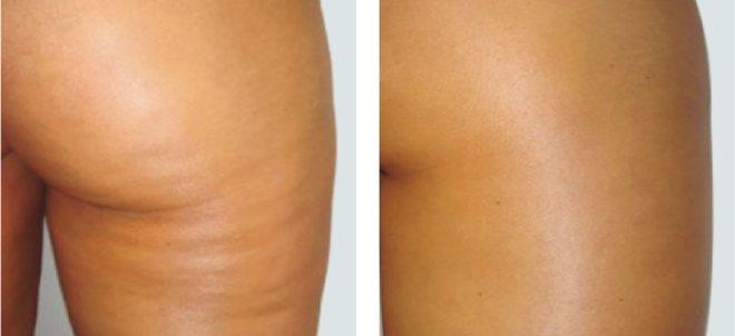 Body result after fifteen sessions