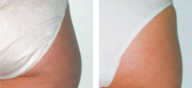 Body result after eight sessions