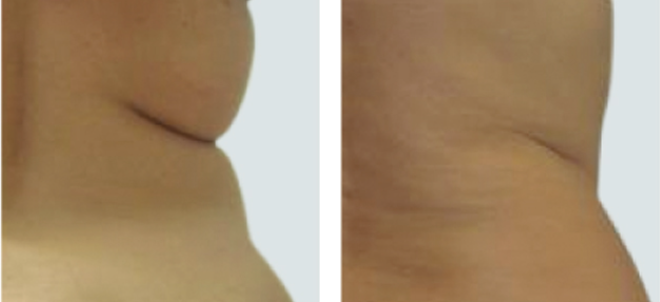 Waist and abdomen before and after