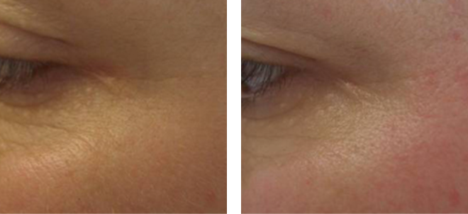 Facial result after one session