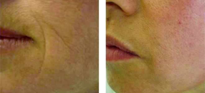 Facial result after three sessions