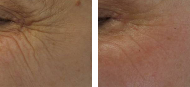 Facial skin texture before and after