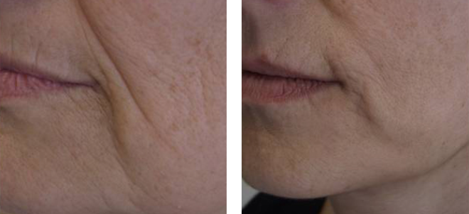 Facial contour before and after